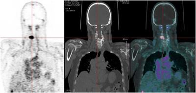 Clinical Results in Medullary Thyroid Carcinoma Suggest High Potential of Pretargeted Immuno-PET for Tumor Imaging and Theranostic Approaches